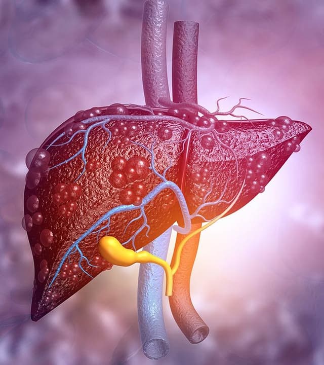 How Fatty Liver Discomfort Feels
